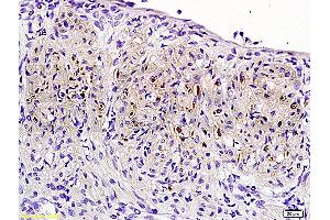 Formalin-fixed and paraffin embedded: rat uterine myoma labeled with Anti-PR (progesterone receptor) Polyclonal Antibody (ABIN725090), Unconjugated 1:200 followed by conjugation to the secondary antibody and DAB staining (Progesterone Receptor Antikörper  (AA 501-600))