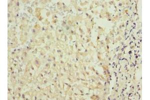Immunohistochemistry of paraffin-embedded human liver cancer using ABIN7172975 at dilution of 1:100