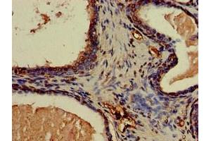 Immunohistochemistry of paraffin-embedded human prostate cancer using ABIN7146559 at dilution of 1:100 (CNN3 Antikörper  (AA 2-329))