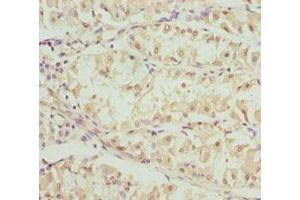 Immunohistochemistry of paraffin-embedded human gastric cancer using ABIN7162248 at dilution of 1:100 (OPA3 Antikörper  (AA 25-179))