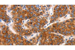 Immunohistochemistry of paraffin-embedded Human liver cancer tissue using KCNC2 Polyclonal Antibody at dilution 1:100 (KCNC2 Antikörper)