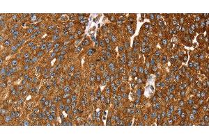 Immunohistochemistry of paraffin-embedded Human breast cancer tissue using RASSF3 Polyclonal Antibody at dilution 1:35 (RASSF3 Antikörper)