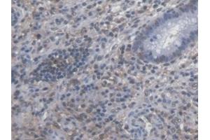 Detection of SYMPK in Human Colorectal cancer Tissue using Polyclonal Antibody to Symplekin (SYMPK) (Symplekin Antikörper  (AA 1-347))