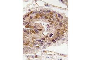 Immunohistochemistry analyzes of paraffin-embedded human colon carcinoma tissue using DIDO1 antibody . (DIDO1 Antikörper)