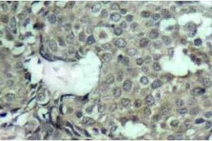Immunohistochemistry (IHC) analyzes of p-MEK-1/2 antibody in paraffin-embedded human breast carcinoma tissue. (MEK1 Antikörper  (pSer222, pSer226))