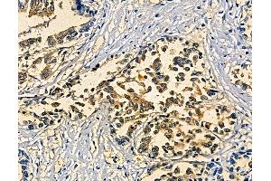 ABIN7094923 and ABIN7098979 at 1/100 staining human pancreatic cancer and adjacent non-tumor tissue by IHC-P. (SOX30 Antikörper)