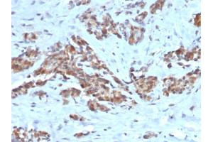 Formalin-fixed, paraffin-embedded human Breast stained with ARF1 Mouse Monoclonal Antibody (ARF1/2117). (ARF1 Antikörper)