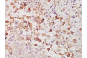 Formalin-fixed and paraffin embedded human lung carcinoma labeled with Rabbit Anti-CK7 Polyclonal Antibody, Unconjugated  at 1:200 followed by conjugation to the secondary antibody and DAB staining (Cytokeratin 7 Antikörper  (AA 251-350))