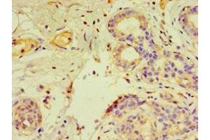 Immunohistochemistry of paraffin-embedded human breast cancer using ABIN7153805 at dilution of 1:100
