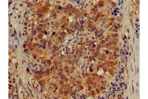 Immunohistochemistry of paraffin-embedded human pancreatic cancer using ABIN7149021 at dilution of 1:100