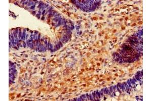 Immunohistochemistry of paraffin-embedded human ovarian cancer using ABIN7167713 at dilution of 1:100 (RMND1 Antikörper  (AA 35-160))