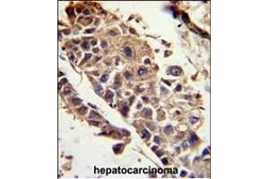 Formalin-fixed and paraffin-embedded human hepatocarcinoma reacted with SERPINF1 Antibody (Center) , which was peroxidase-conjugated to the secondary antibody, followed by DAB staining. (PEDF Antikörper  (AA 279-306))