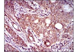 Immunohistochemical analysis of paraffin-embedded cervical cancer tissues using DCTN4 mouse mAb with DAB staining. (Dynactin 4 Antikörper  (AA 57-298))