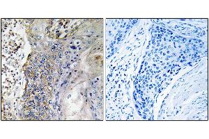 Immunohistochemistry analysis of paraffin-embedded human lung carcinoma tissue, using SLC28A2 antibody. (SLC28A2 Antikörper)