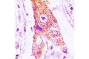 Immunohistochemical analysis of MRPL46 staining in human lung cancer formalin fixed paraffin embedded tissue section. (MRPL46 Antikörper  (Center))