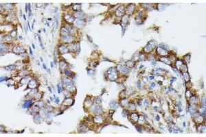 Immunohistochemistry of paraffin-embedded Human lung cancer using MTIF2 Polyclonal Antibody at dilution of 1:100 (40x lens). (MTIF2 Antikörper)
