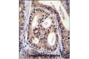 CYTSA Antibody (N-term) (ABIN656040 and ABIN2845411) immunohistochemistry analysis in formalin fixed and paraffin embedded human prostate carcinoma followed by peroxidase conjugation of the secondary antibody and DAB staining. (SPECC1L Antikörper  (N-Term))