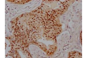 IHC image of ABIN7127775 diluted at 1:100 and staining in paraffin-embedded human prostate cancer performed on a Leica BondTM system.