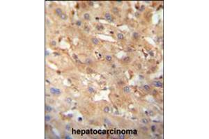NEU4 antibody immunohistochemistry analysis in formalin fixed and paraffin embedded human hepatocarcinoma followed by peroxidase conjugation of the secondary antibody and DAB staining. (Sialidase 4 Antikörper  (C-Term))