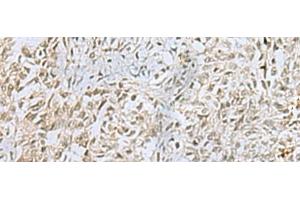Immunohistochemistry of paraffin-embedded Human ovarian cancer tissue using FOXQ1 Polyclonal Antibody at dilution of 1:25(x200) (FOXQ1 Antikörper)