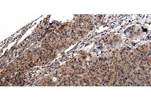 Immunohistochemistry of paraffin-embedded Human cervical cancer tissue using RAB41 Polyclonal Antibody at dilution 1:100