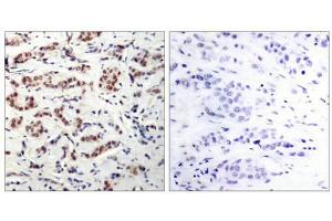 Immunohistochemical analysis of paraffin-embedded human breast carcinoma tissue using STAT5A(Phospho-Tyr694) Antibody(left) or the same antibody preincubated with blocking peptide(right). (STAT5A Antikörper  (pTyr694))