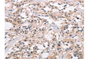 The image on the left is immunohistochemistry of paraffin-embedded Human thyroid cancer tissue using ABIN7190329(COL7A1 Antibody) at dilution 1/25, on the right is treated with synthetic peptide. (COL7A1 Antikörper)