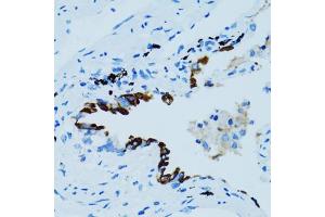 Immunohistochemistry of paraffin-embedded human lung cancer using CTSE antibody (ABIN5971444) at dilution of 1/100 (40x lens). (Cathepsin E Antikörper)