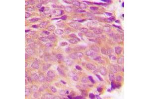 Immunohistochemical analysis of Transglutaminase 2 staining in human breast cancer formalin fixed paraffin embedded tissue section. (Transglutaminase 2 Antikörper  (N-Term))