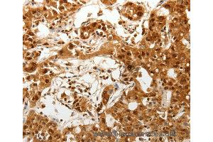 Immunohistochemistry of Human lung cancer using TENM3 Polyclonal Antibody at dilution of 1:50