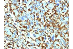 Formalin-fixed, paraffin-embedded human Histiocytoma stained with Factor XIIIa Mouse Monoclonal Antibody (F13A1/1448). (F13A1 Antikörper  (AA 46-181))