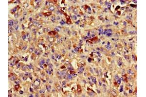 Immunohistochemistry of paraffin-embedded human melanoma using ABIN7145083 at dilution of 1:100 (Aurora Kinase C Antikörper  (AA 12-143))