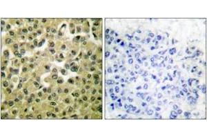 Immunohistochemistry analysis of paraffin-embedded human breast carcinoma tissue, using MCL1 Antibody. (MCL-1 Antikörper  (AA 91-140))