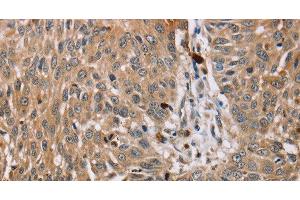 Immunohistochemistry of paraffin-embedded Human lung cancer tissue using PDLIM7 Polyclonal Antibody at dilution 1:35 (PDLIM7 Antikörper)
