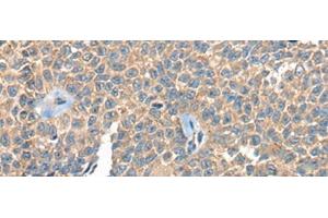 Immunohistochemistry of paraffin-embedded Human ovarian cancer tissue using PPP3R1 Polyclonal Antibody at dilution of 1:55(x200) (PPP3R1 Antikörper)