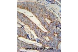 DACT1 antibody (N-term) (ABIN652102 and ABIN2840549) immunohistochemistry analysis in formalin fixed and paraffin embedded human prostate carcinoma followed by peroxidase conjugation of the secondary antibody and DAB staining. (DACT1 Antikörper  (N-Term))