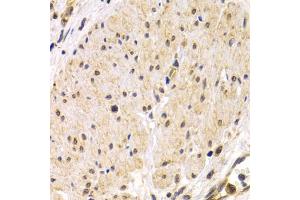 Immunohistochemistry of paraffin-embedded human stomach cancer using TMPRSS2 antibody (ABIN5975349) at dilution of 1/200 (40x lens). (TMPRSS2 Antikörper)