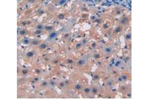 IHC-P analysis of Human Liver Cancer Tissue, with DAB staining. (Integrin beta 5 Antikörper  (AA 137-378))