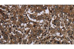 Immunohistochemistry of paraffin-embedded Human liver cancer tissue using GLIPR1 Polyclonal Antibody at dilution 1:50 (GLIPR1 Antikörper)