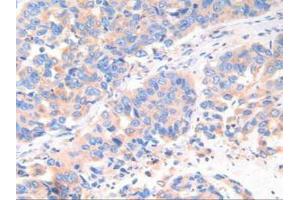 IHC-P analysis of Human Breast Cancer Tissue, with DAB staining. (Cathepsin K Antikörper  (AA 54-317))