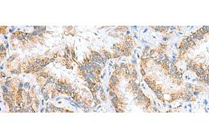 Immunohistochemistry of paraffin-embedded Human lung cancer tissue using RIDA Polyclonal Antibody at dilution of 1:65(x200) (HRSP12 Antikörper)
