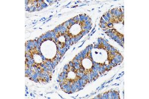 Immunohistochemistry of paraffin-embedded human colon carcinoma using Bax antibody (ABIN7265858) at dilution of 1:100 (40x lens). (BAX Antikörper)