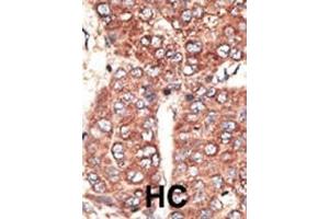 Formalin-fixed and paraffin-embedded human cancer tissue reacted with the primary antibody, which was peroxidase-conjugated to the secondary antibody, followed by AEC staining. (LRP2 Antikörper  (C-Term))