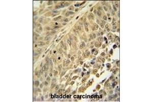 HNRNPC antibody (C-term) (ABIN654685 and ABIN2844378) immunohistochemistry analysis in formalin fixed and paraffin embedded human bladder carcinoma followed by peroxidase conjugation of the secondary antibody and DAB staining. (HNRNPC Antikörper  (C-Term))