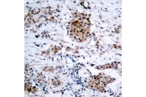Immunohistochemistry of paraffin-embedded human breast carcinoma using Phospho-ESR1-S167 antibody (ABIN2988007). (Estrogen Receptor alpha Antikörper  (pSer167))