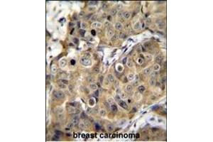 TME Antibody (C-term) (ABIN655659 and ABIN2845131) immunohistochemistry analysis in formalin fixed and paraffin embedded human breast carcinoma followed by peroxidase conjugation of the secondary antibody and DAB staining. (TMEM100 Antikörper  (C-Term))