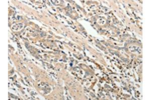 The image on the left is immunohistochemistry of paraffin-embedded Human gastric cancer tissue using ABIN7189660(ADAMTS2 Antibody) at dilution 1/25, on the right is treated with synthetic peptide. (Adamts2 Antikörper)