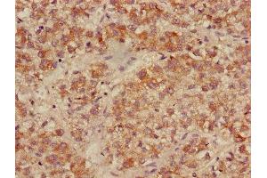 Immunohistochemistry of paraffin-embedded human liver cancer using ABIN7158499 at dilution of 1:100 (ACADL Antikörper  (AA 30-260))