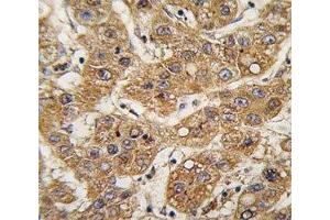 IHC analysis of FFPE human hepatocarcinoma tissue stained with ApoE antibody (APOE Antikörper  (AA 263-292))