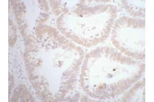 Immunohistochemistry (IHC) staining of human rectal cancer tissue, diluted at 1:200. (CDX2 Antikörper)